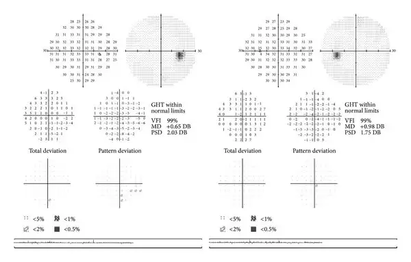2 phút cùng Bác sĩ #81 – Đo thị trường mắt