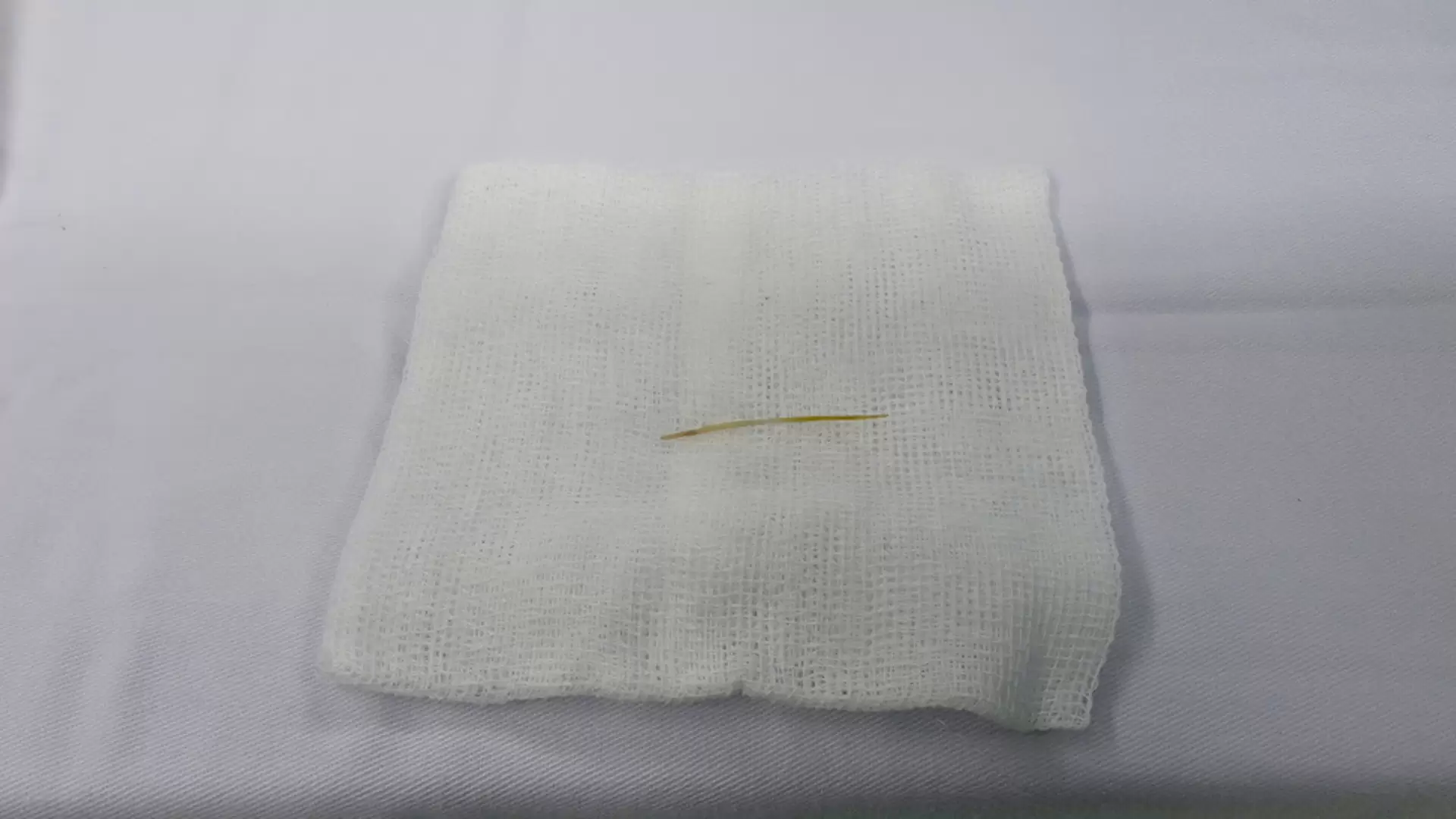 Phẫu thuật thành công trường hợp xương cá gây thủng ruột (12/3/2026)