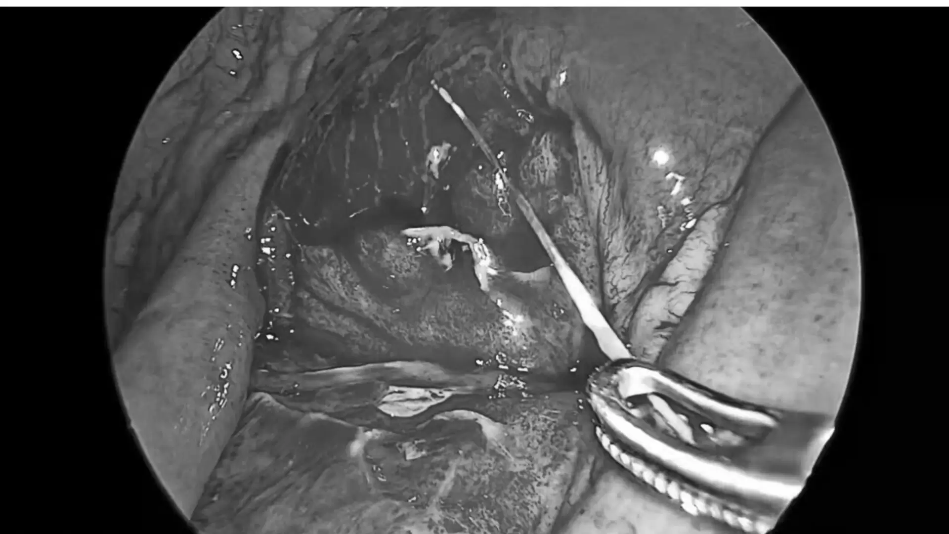 Phẫu thuật thành công trường hợp xương cá gây thủng ruột (12/3/2026)