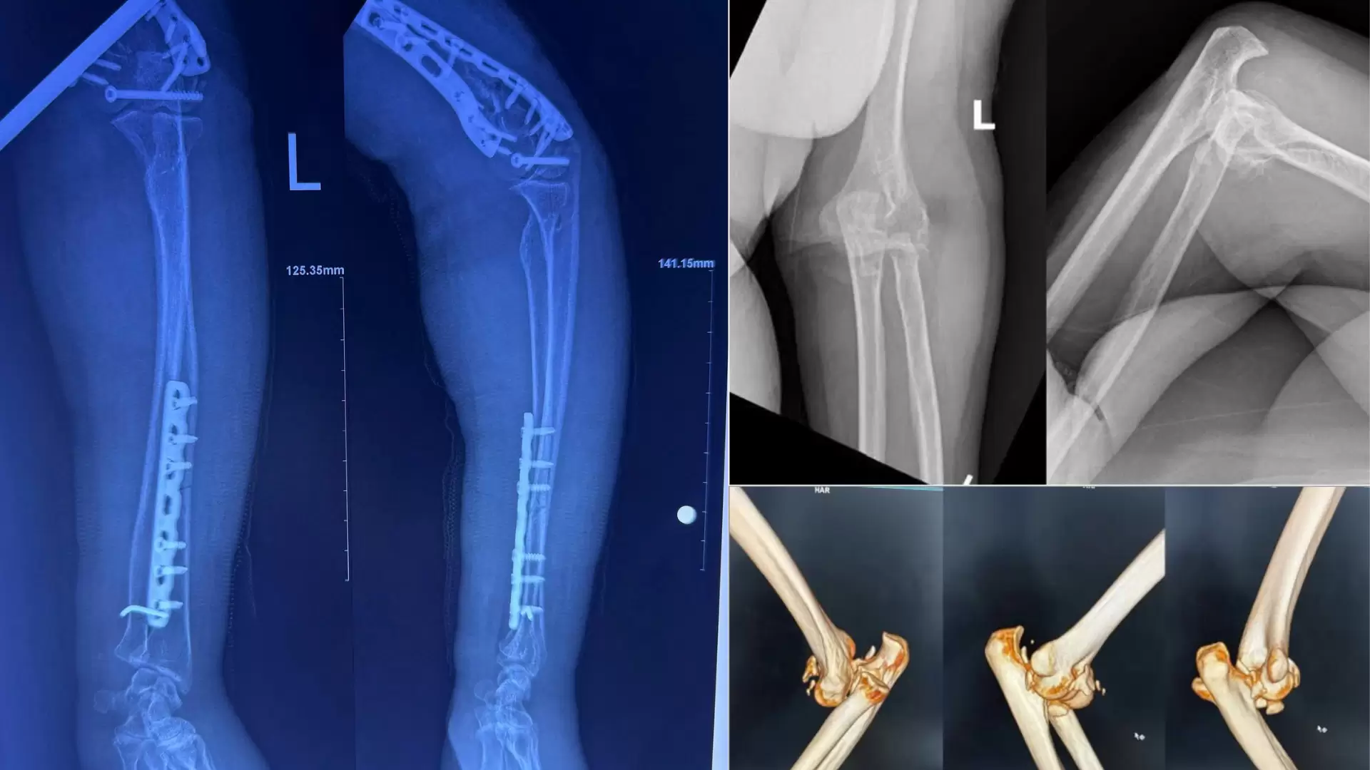 Gãy xương phức tạp kèm trật khớp ở người cao tuổi: thách thức và thành công tại An Bình