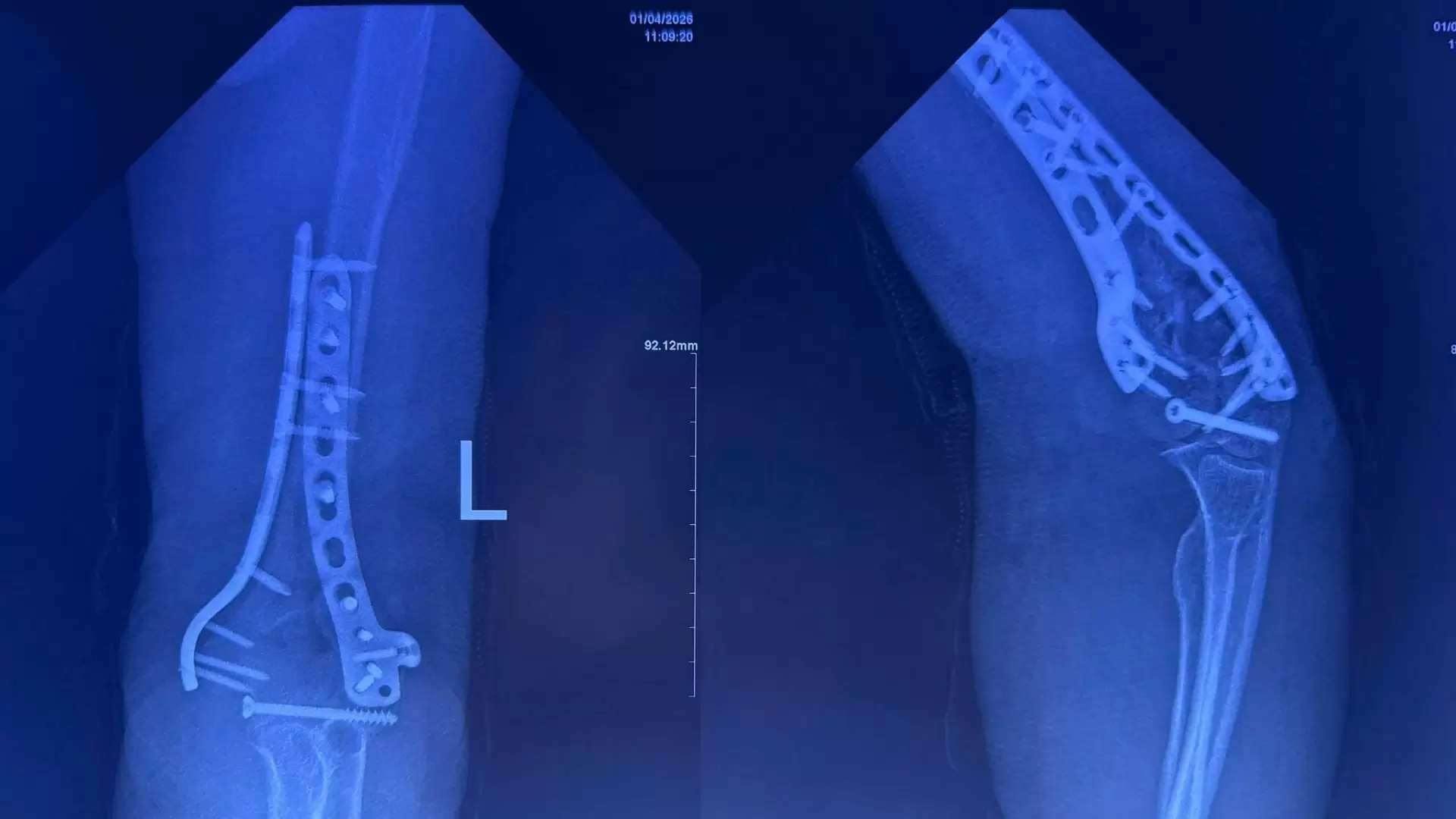 Gãy xương phức tạp kèm trật khớp ở người cao tuổi: thách thức và thành công tại An Bình