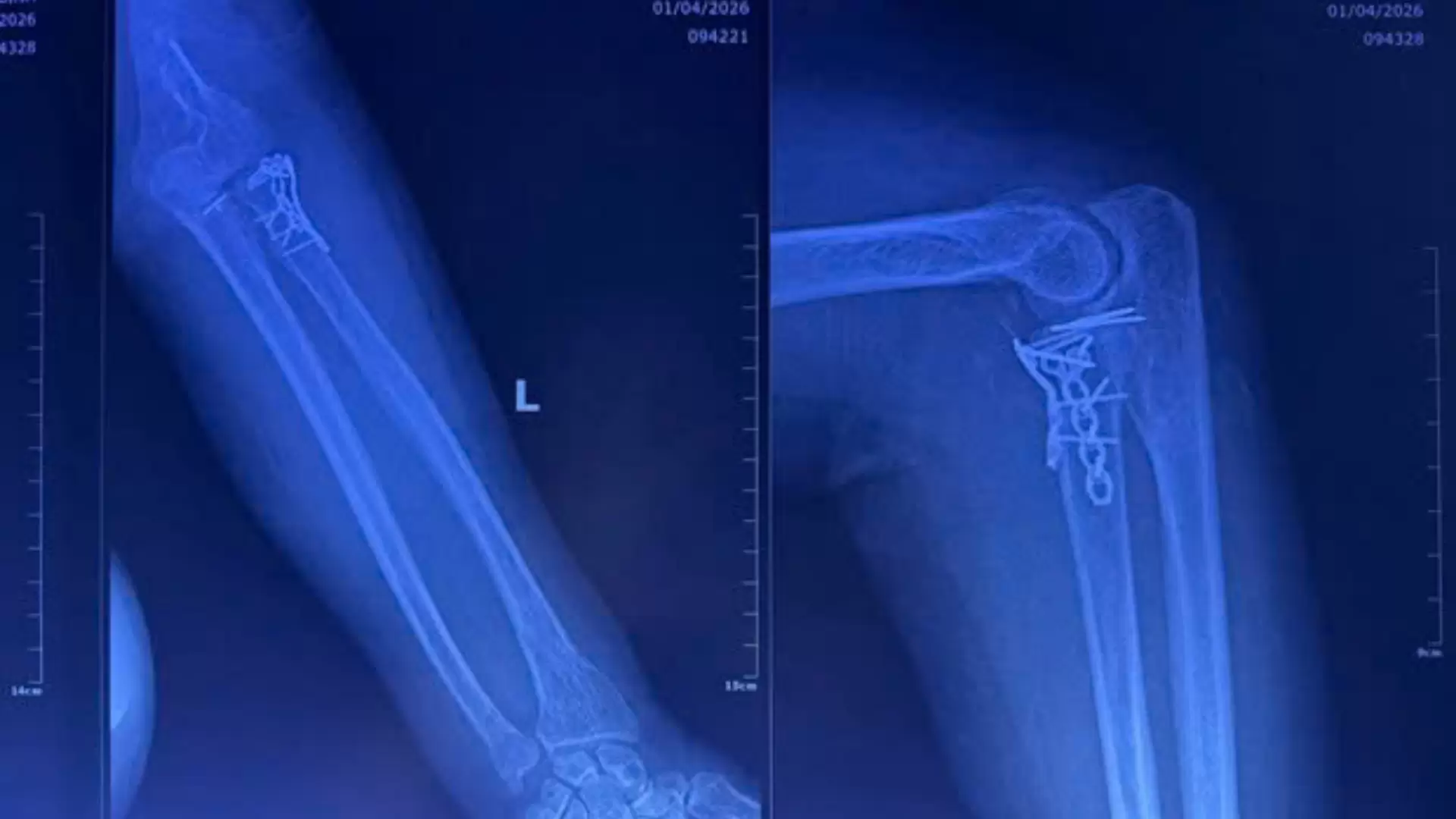 Gãy xương phức tạp kèm trật khớp ở người cao tuổi: thách thức và thành công tại An Bình