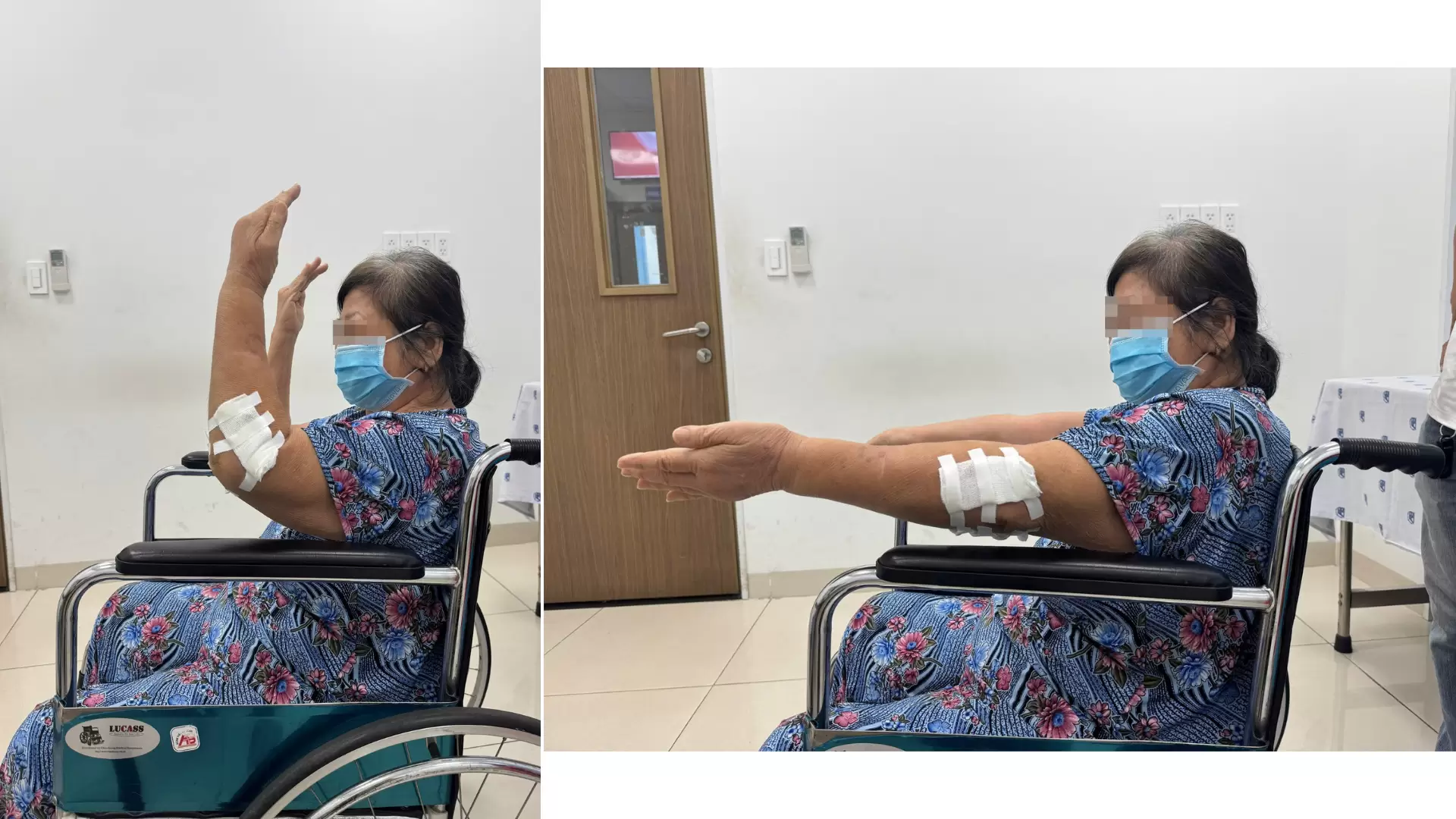 Gãy xương phức tạp kèm trật khớp ở người cao tuổi: thách thức và thành công tại An Bình