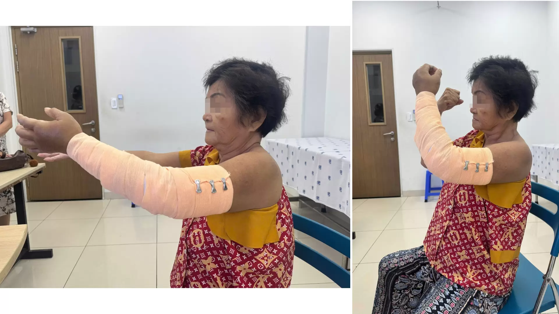 Gãy xương phức tạp kèm trật khớp ở người cao tuổi: thách thức và thành công tại An Bình