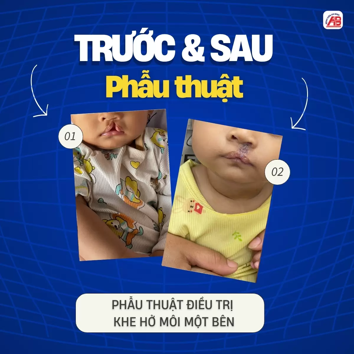 Hành trình tìm lại nụ cười cho trẻ thơ