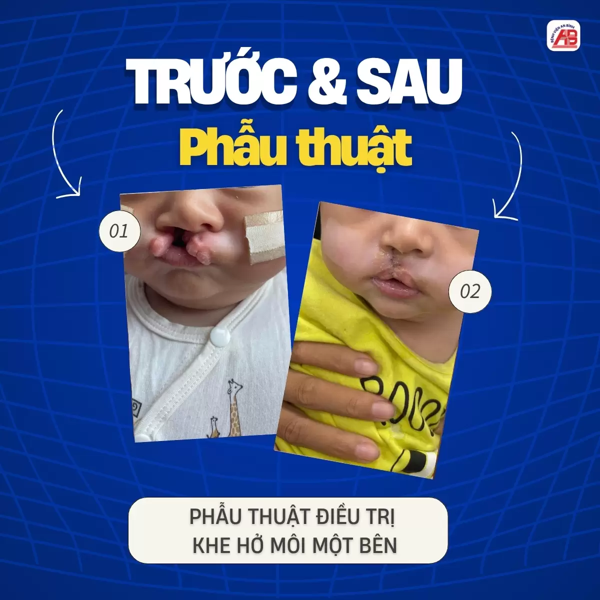 Hành trình tìm lại nụ cười cho trẻ thơ