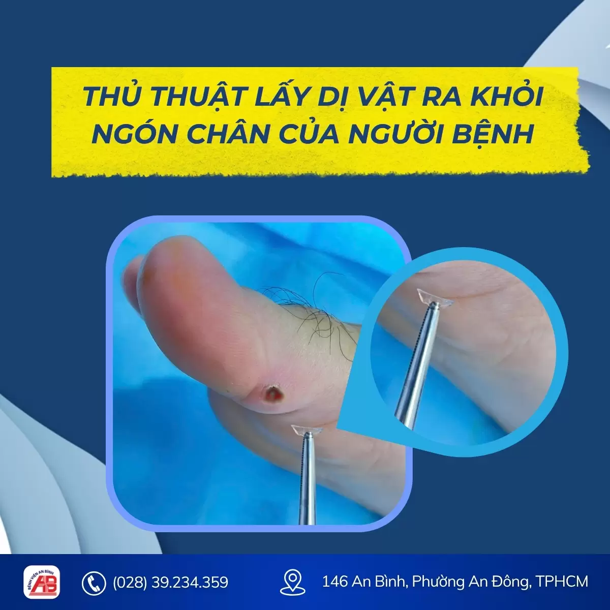 Ngón chân sưng đau suốt nhiều ngày, nguyên nhân từ miếng miểng chai… từ 2 năm trước