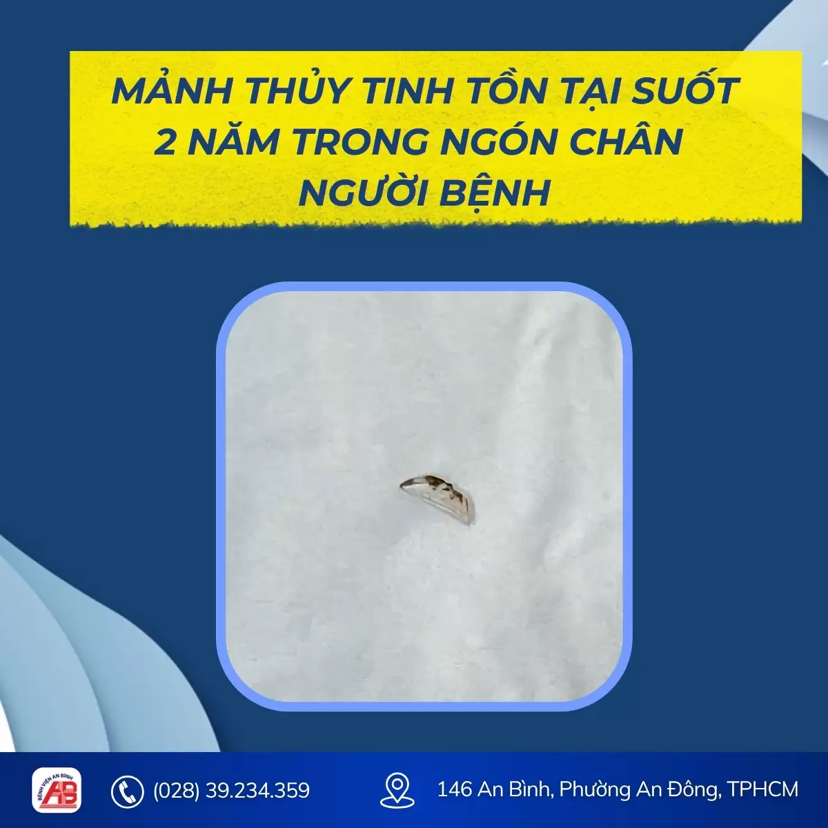 Ngón chân sưng đau suốt nhiều ngày, nguyên nhân từ miếng miểng chai… từ 2 năm trước