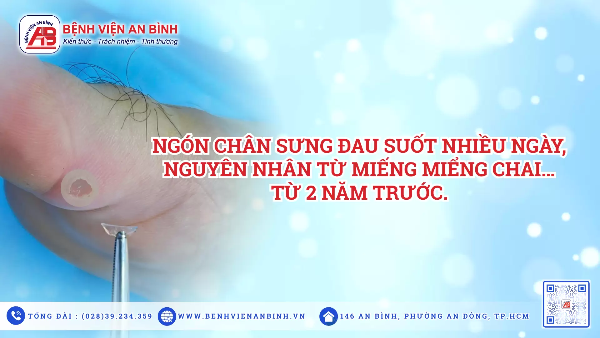Ngón chân sưng đau suốt nhiều ngày, nguyên nhân từ miếng miểng chai… từ 2 năm trước