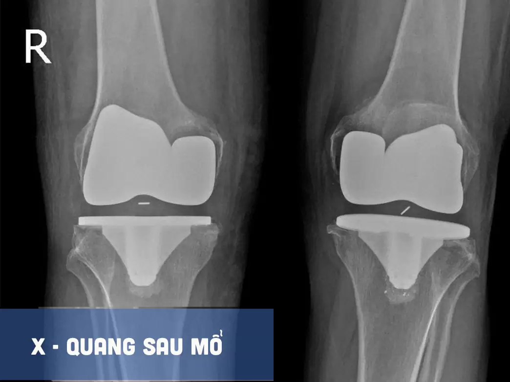 Một người lính, hai lần được nâng bước