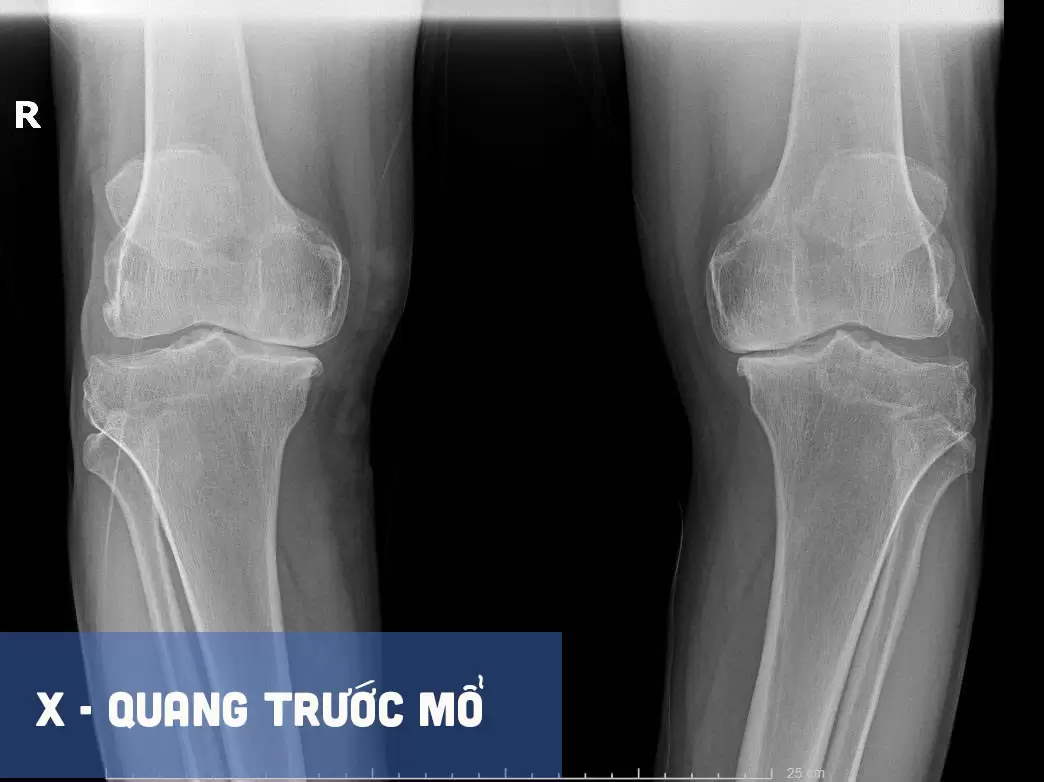 Một người lính, hai lần được nâng bước