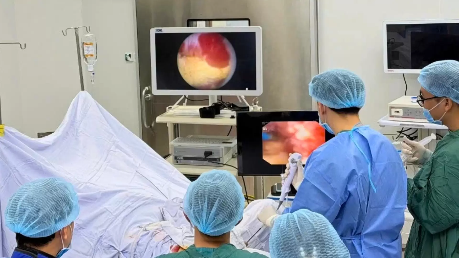 Triển khai kỹ thuật ECIRS điều trị thành công “Sỏi thận san hô phức tạp”