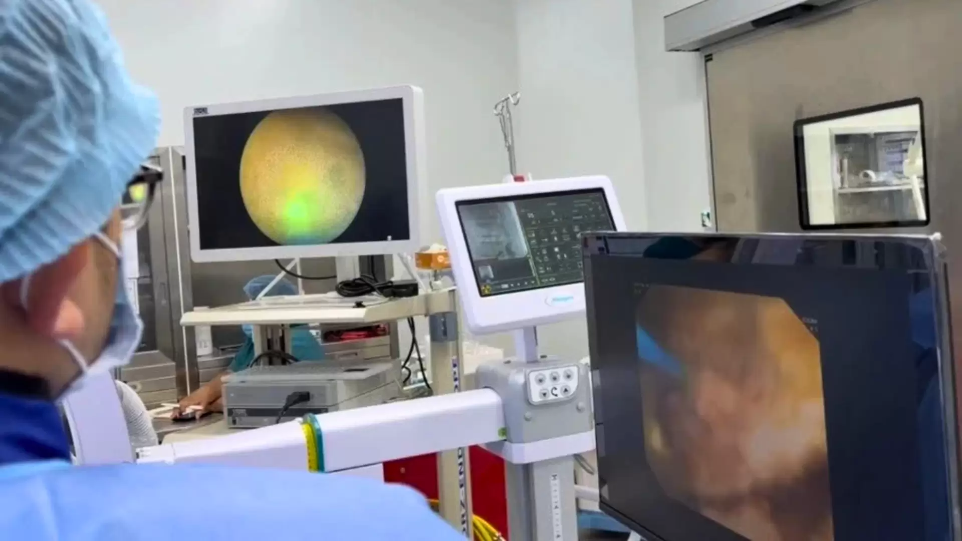 Triển khai kỹ thuật ECIRS điều trị thành công “Sỏi thận san hô phức tạp”
